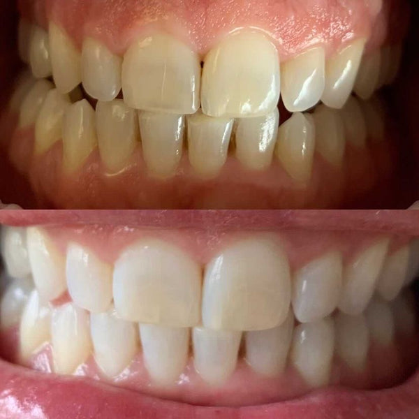 Home teeth whitening by a dental nurse